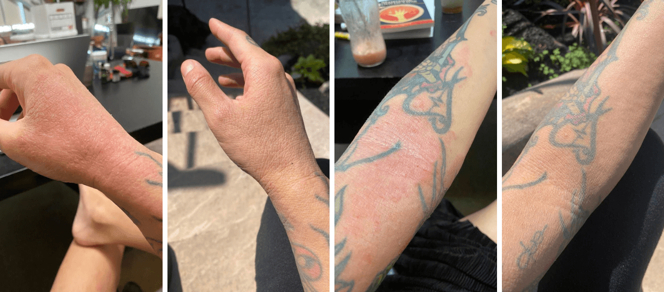 Eczema: A Healing Journey Q&A - Viva Health Skincare
